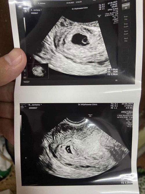 อัลตราซาวด์ 4-5week