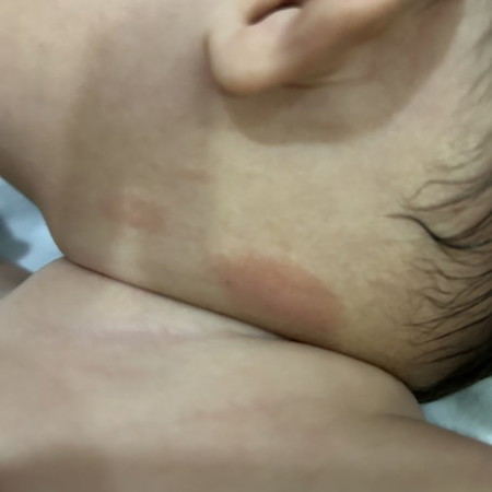 Ni apa? Eczema?