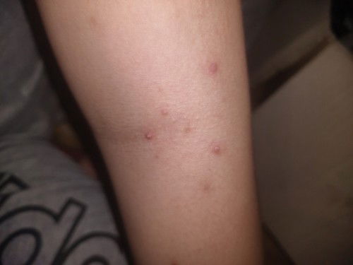 Ada yang pernah ngalamin gini ga di sini udh 11 bulan ga sembuh sembuh gatal kya gini di semua badan