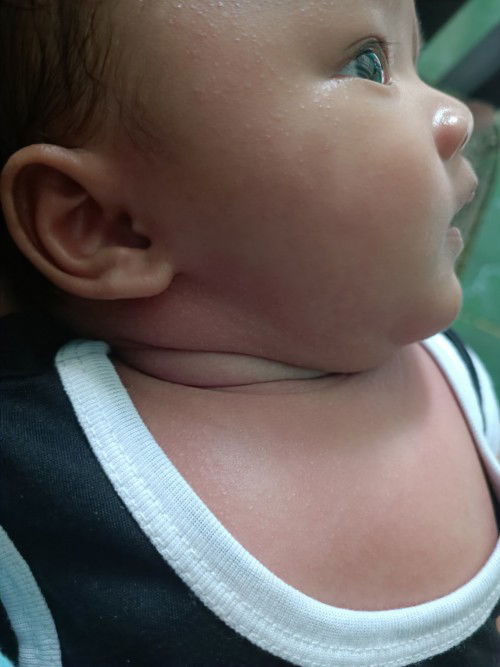 Kulit merah bruntusan