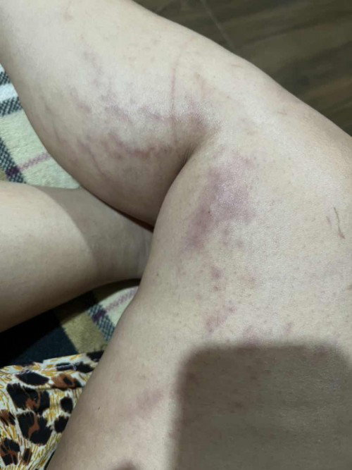 มีอาการขาแตกลายแก้ยังไง?!