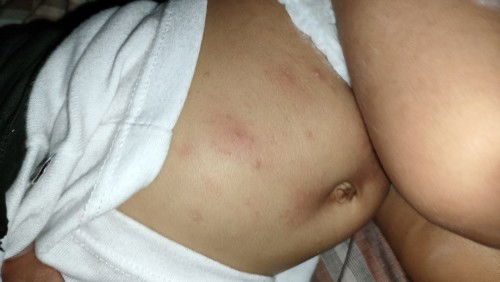 Ada yg punya dedek seperti foto ini ga Bun,,sharing pengalamannya , sudah juga dibawa ke DS kulit