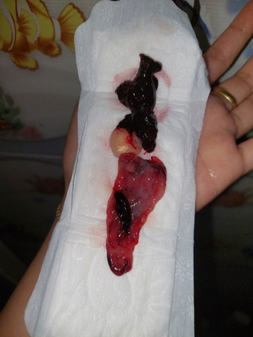 Bedrest 3hari, dan barusan pagi ini keluar gumpalan ini bun🥺