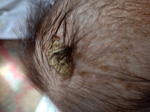 Cradle cap ni LO