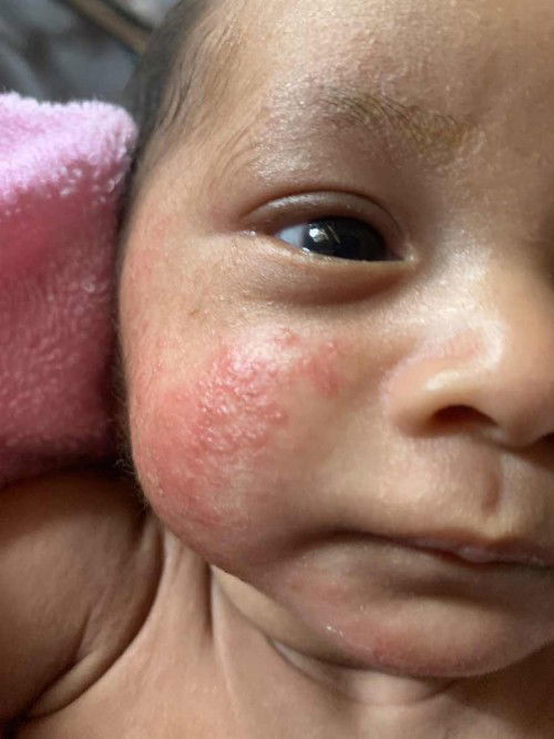 ผื่นขึ้นเเบบนี้ทำยังไงดีคะ