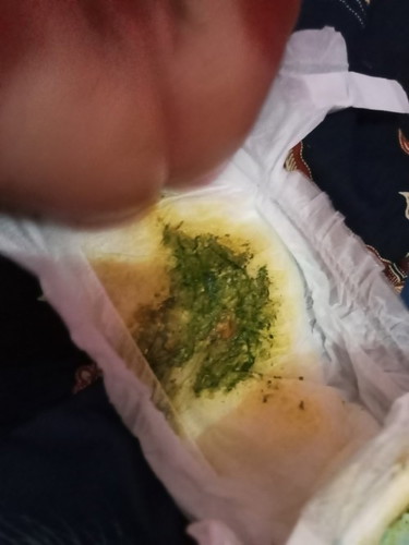 bayi sy2 bulan, kemarinhabis inunisai dpt1, skrgpanas sama pupnya warna ijo, apa sy hrs ke bidan/Dr