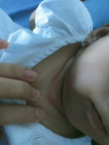 Lipatan pada leher bayi tidak kunjung hilang warna merahnya