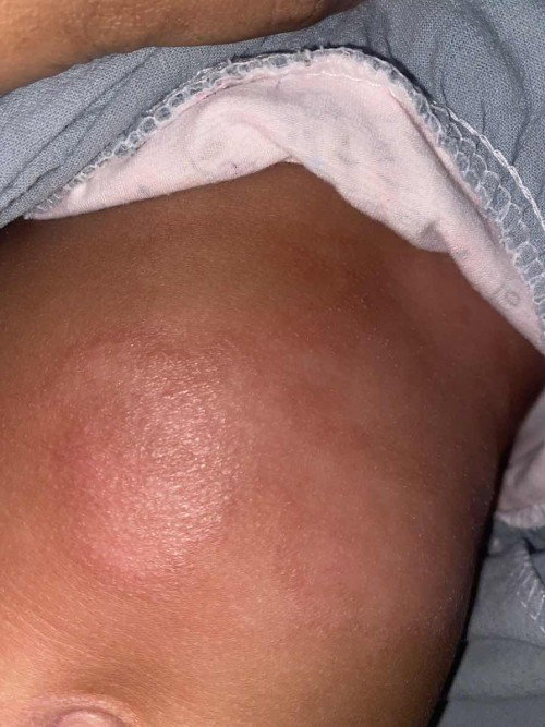 Bintik di badan jadi melebar kaya luka bakar