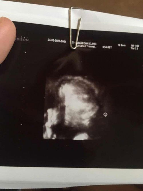 อัลตราชาวด์ภาพ3มิติ