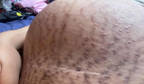 ขอวิธีรักษาท้องลายหน่อยค่ะแม่ๆ