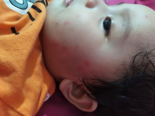 Bun, mau nanya dong ini bintik merah kenapa ya? Dan munculnya cuma di sebelah kiri aja