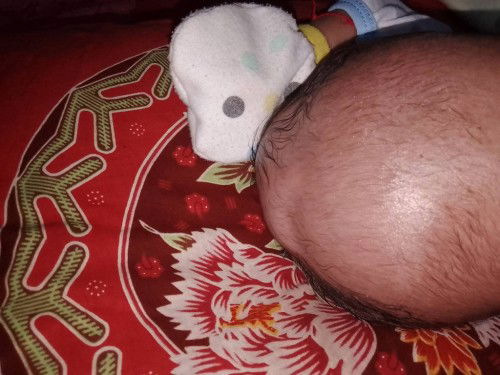 Kepala bayi benjol lembek