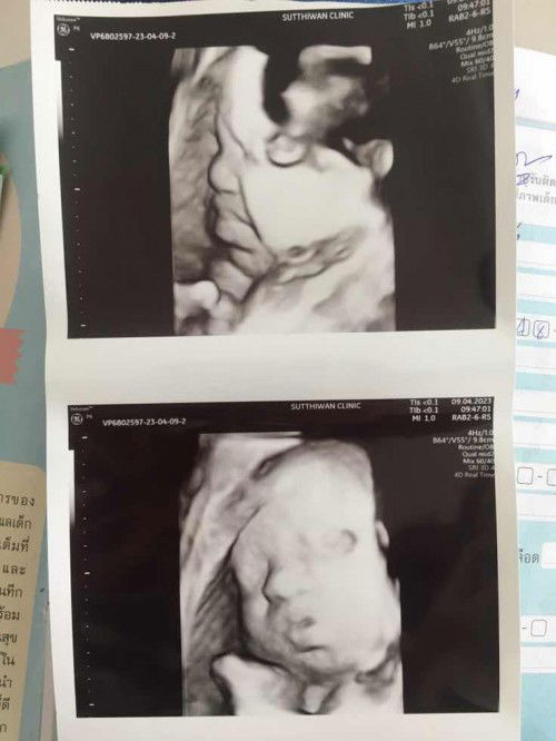 33+6 สายสะดือพันคอค่ะ