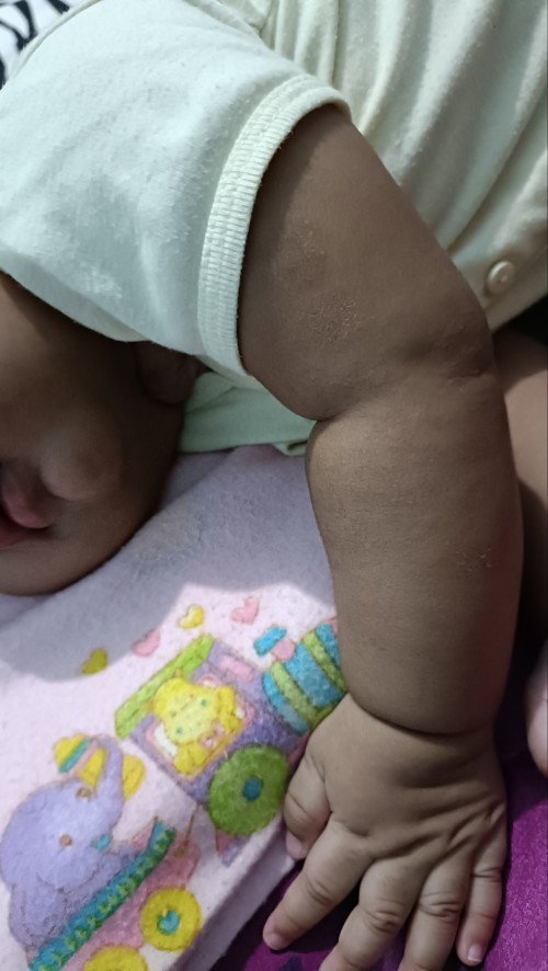 Kulit bercak hitam dan kering