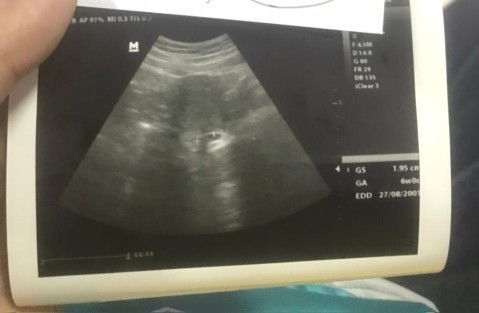 Hamil 6week tp baru kantong ada yg sama ngga bun?