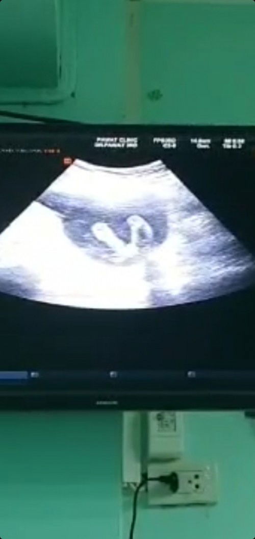 สอบถามจ้า น้องจะเป็น ผญ หรือ ผช ค่ะ
แม่ตื่นเต้น หมอนัดอีกที 28/4/66