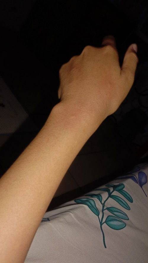 Gatal telapak tangan dan kaki