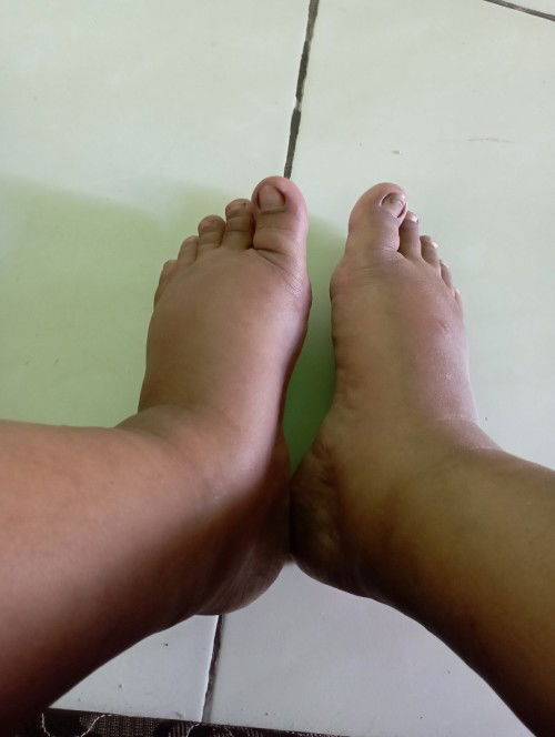 Kaki sering bengkak