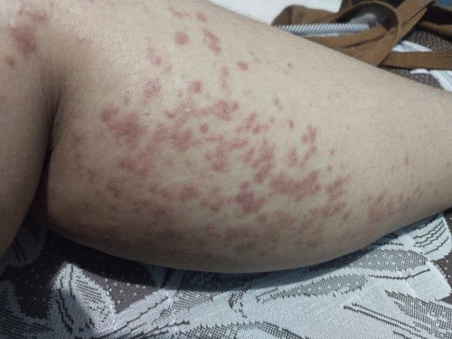 Gatal gatal selyruh tubuh