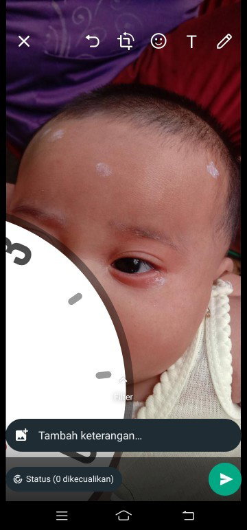 Bayi 2bulan ruam