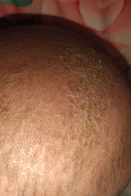 Kepala anak berkerak