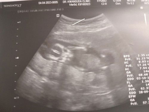 ท้องได้4เดือนแต่น้องงอขาเลยไม่รู้เพศ