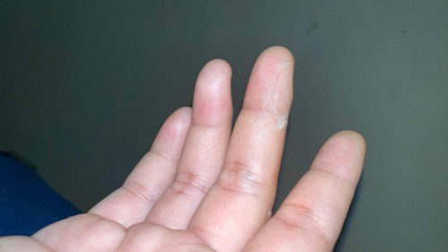 อันนี้คือตกขาวใช่ไหมคะ