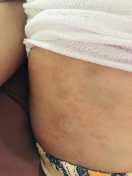 Bayi 7 bulan ruam/Alergi ?