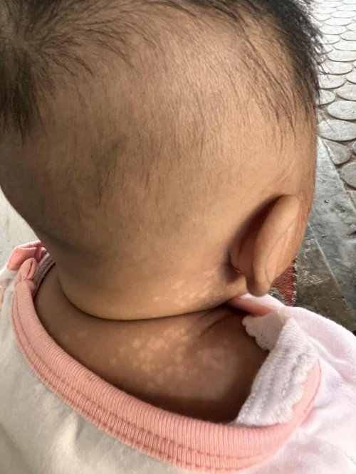 Bercak putih pada bayi