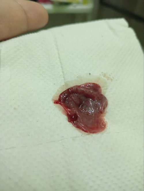 Normal period atau keguguran