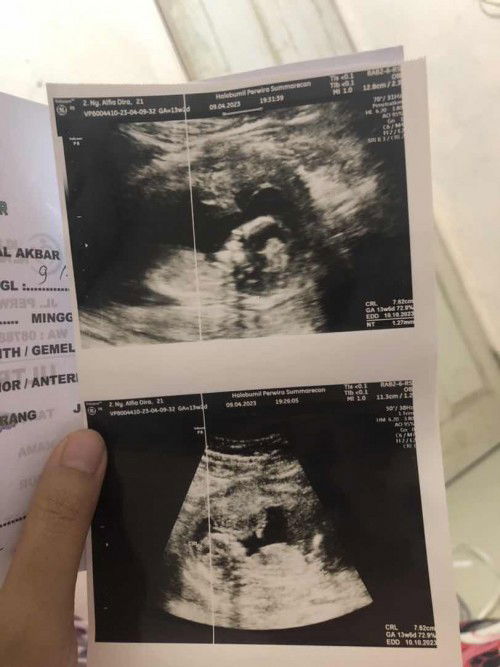 Usia janin tdk sesuai