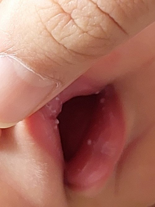 Bintik Putih pada Bibir