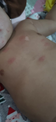 E bé bị nỗi đỏ cac m cho e hoi nay phai bị di ứng hay không vay e mơi bị 1 ngay ha co gì thoa k