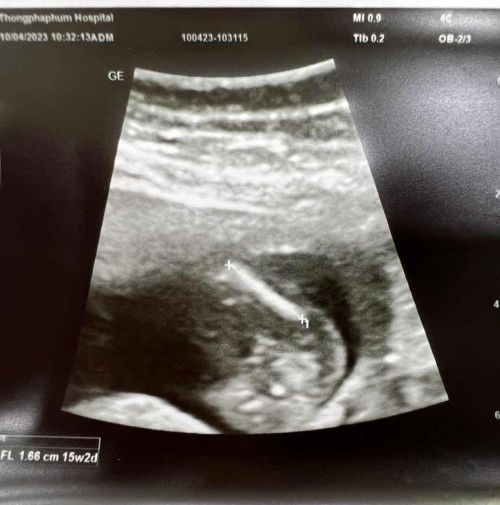 ภาพอัลตราซาวด์