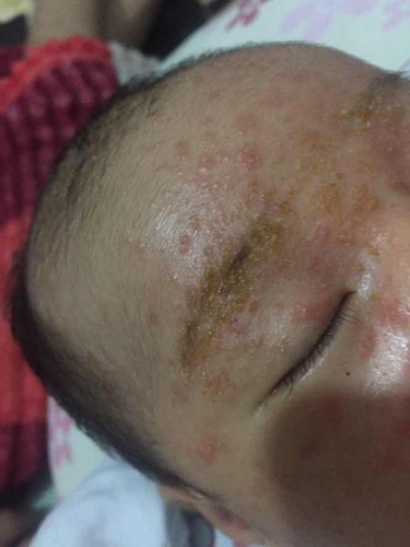 Rashes ni baby