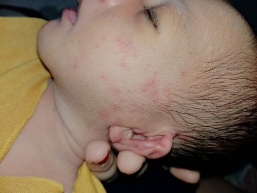Pipi merah bruntusan bayi 2mnggu