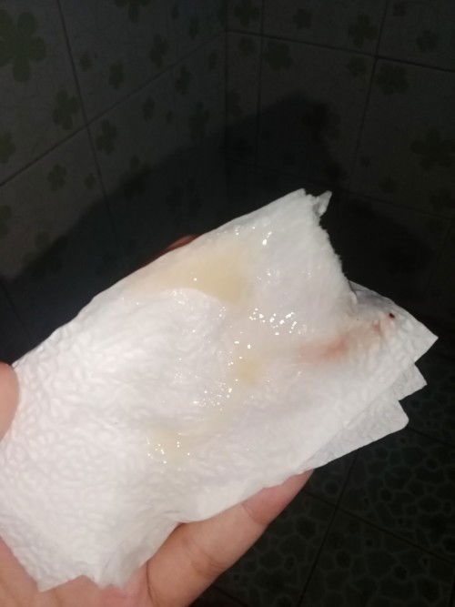 สอบถามเเม่หน่อยๆค่ะ เป็นมูกเเบบนี้ควรไปหาหมอเลยไหมค่ะ ไม่มีอาการปวดท้องถี่ 37+6 ไม่มีอาการน้ำเดิน