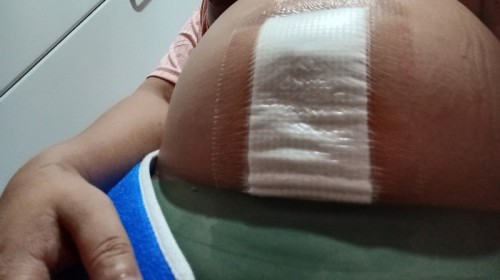 Cesarean section