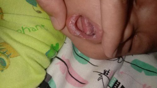 Bercak putih di mulut bayi