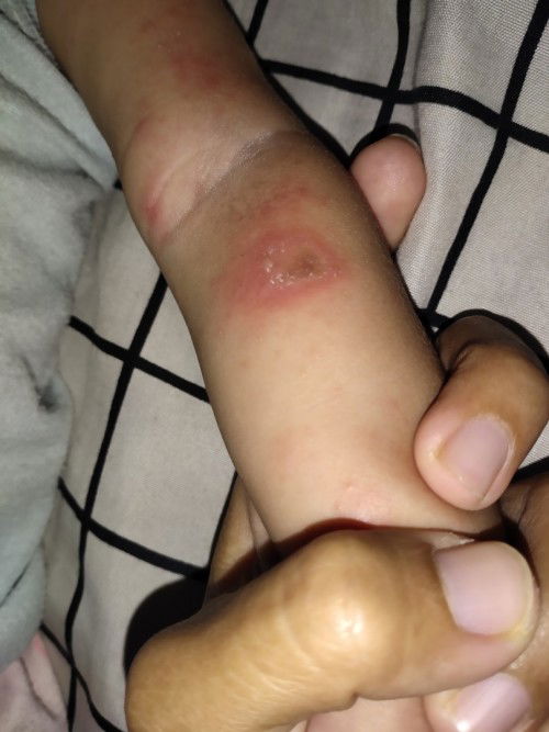 Bekas digigit nyamuk