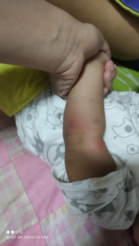 LAGI NALANG MAY GANITO SI BABY RASHES ? BA O ANO KAYA ITO?