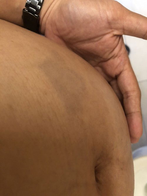 Perut tiba-tiba memar