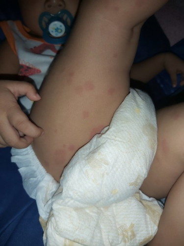Good eve po, my baby is 1yr. And 6 mos. May red spots po xa sa lower limbs. Do u hv any idea po nto?