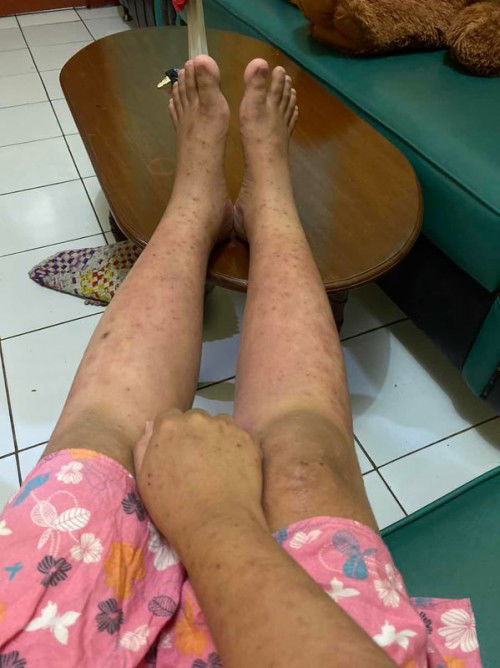 Gatel2 pada tubuh bumil