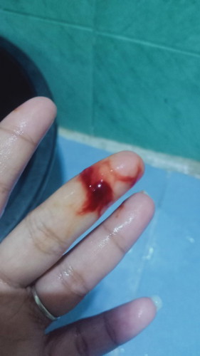 Extreme headache and bleeding without cramps