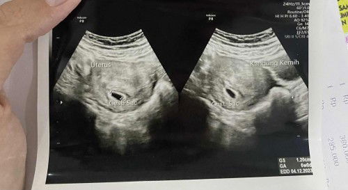 bentuk kantong janin