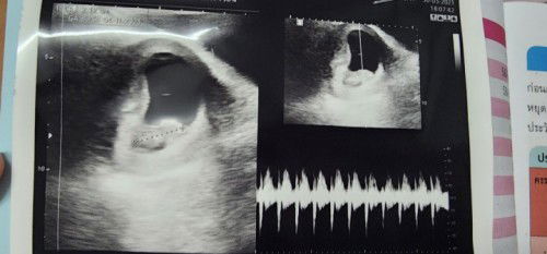 ซาวด์รอบแรกหมอบอกท้องได้ 8 สัปดาห์ 5 วัน