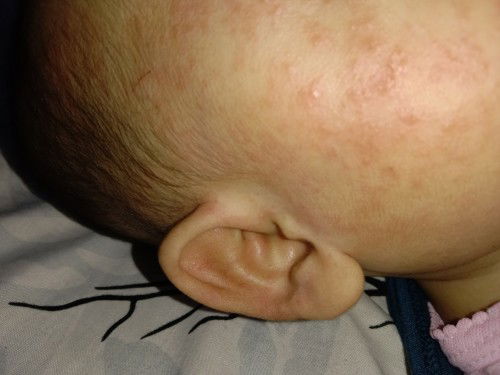 Pipi bayi merah gatal