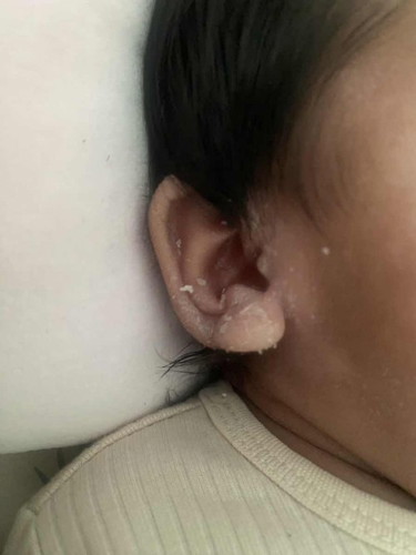 Kulit kering