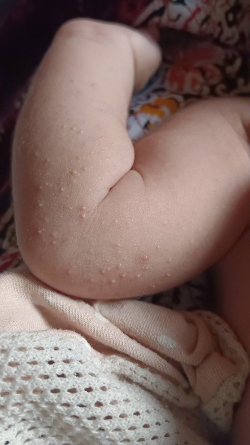 Bintik2 pada baby